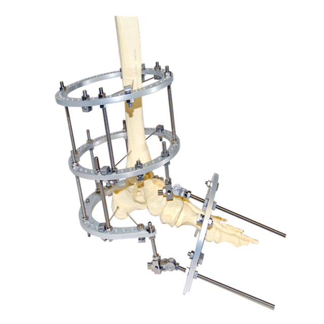复杂的OOT畸形Ilizarov固定器