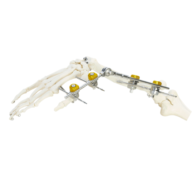 手腕外部固定器（集成）