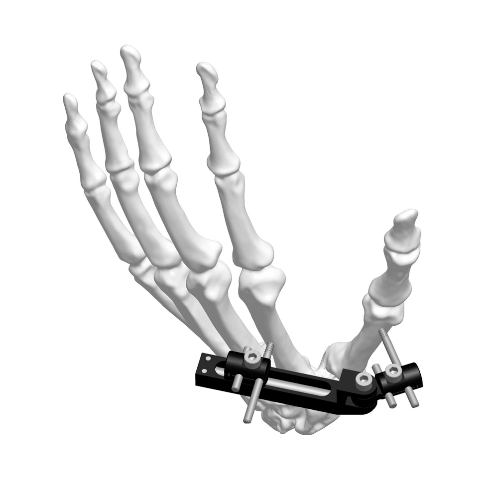 迷你外固定支架（直角型）