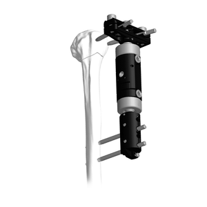 下肢微动外固定器（T型）