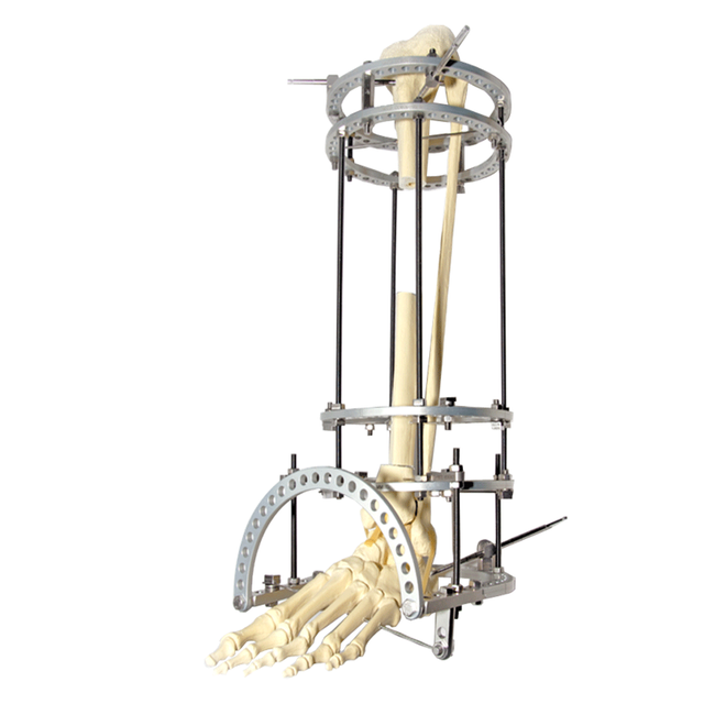 胫骨运输Ilizarov固定器