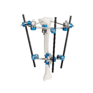 胫骨近端外部固定器II