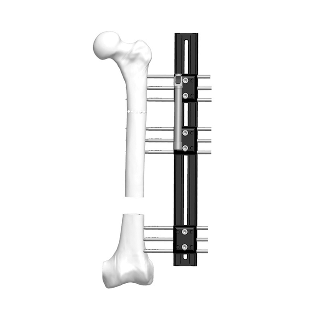 肢体重建系统（LRS）