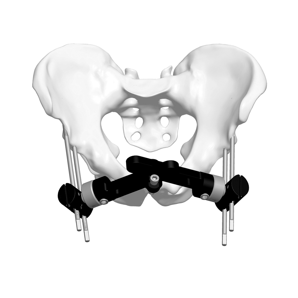 骨盆外固定支架（双链）