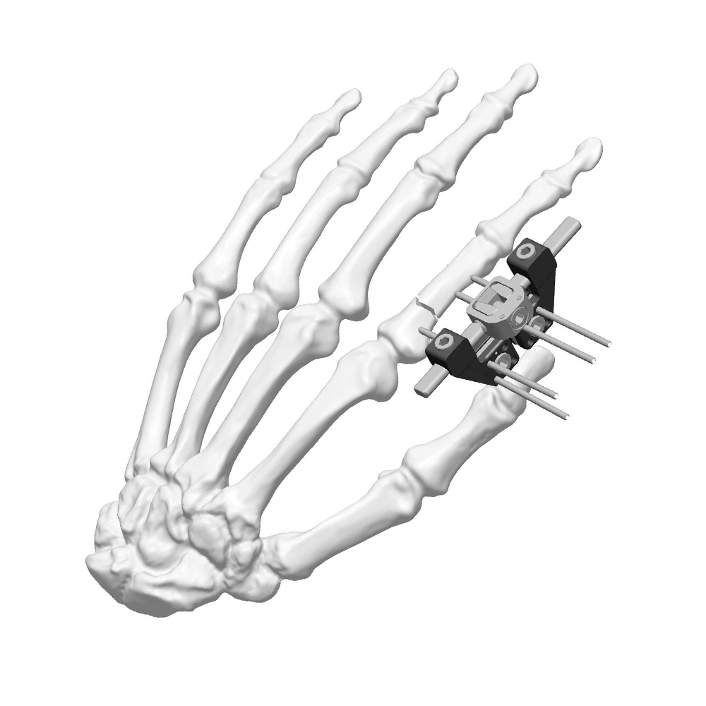 迷你外固定支架（L型）