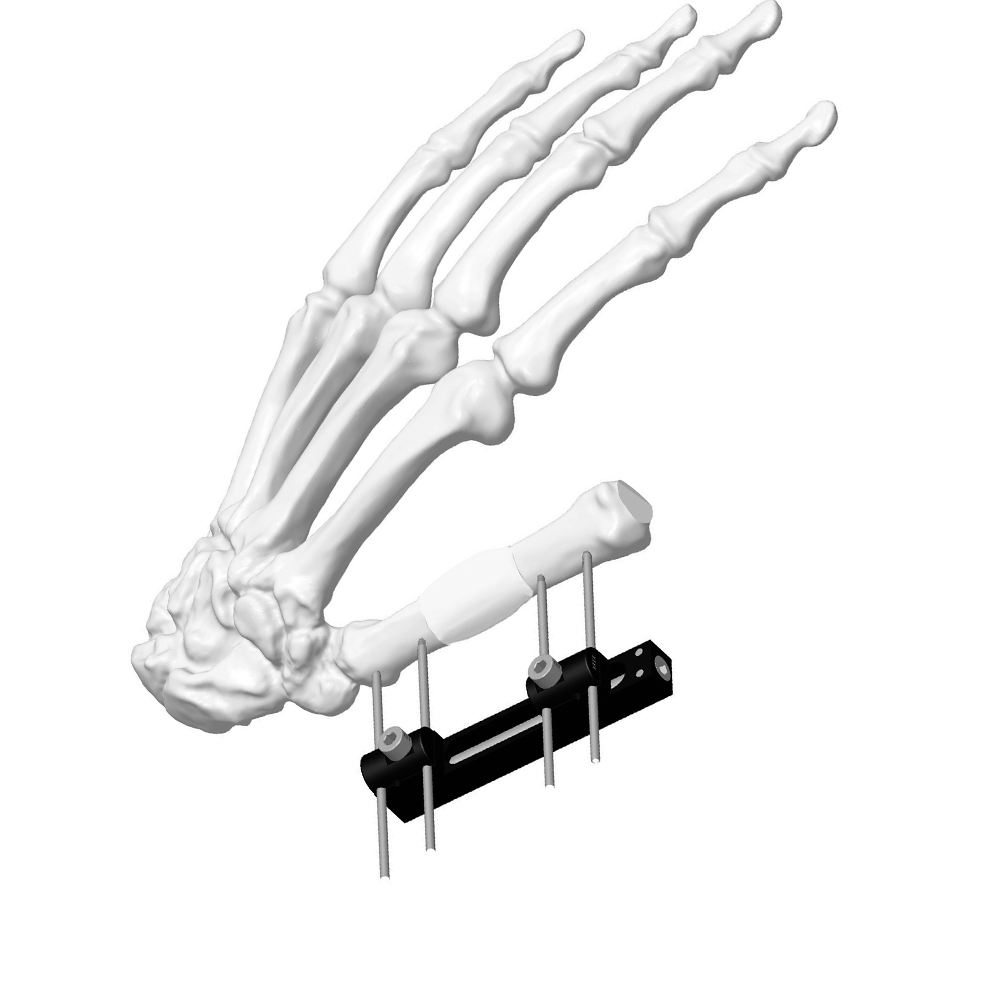 迷你外固定支架（轨道型）