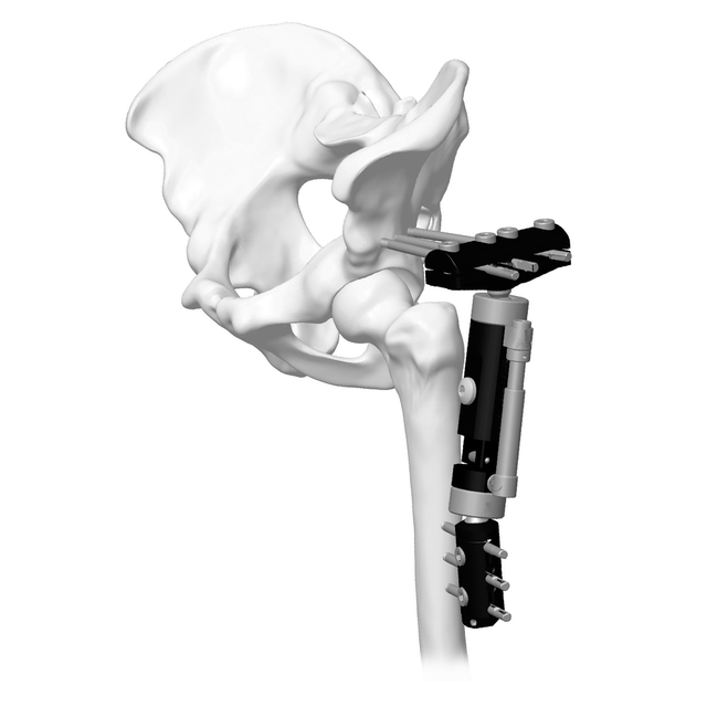 下肢微动外固定器（大T型）