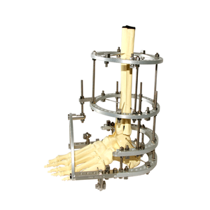 脚踝融合Ilizarov固定器