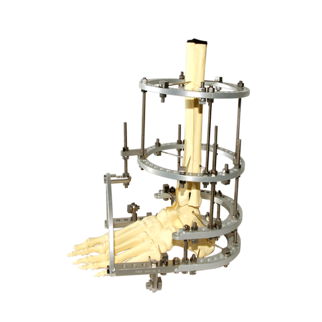 脚踝融合Ilizarov固定器